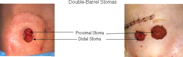Double-Barrel Ostomies
