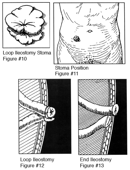 ileostomy diagram what is a loop ileostomy central ok ostomy ileostomy diagram what is a loop ileostomy central ok ostomy