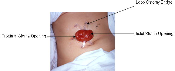 Photo of Loop Colostomy with Bridge