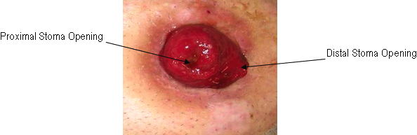 Photo of Loop Ostomy Stoma